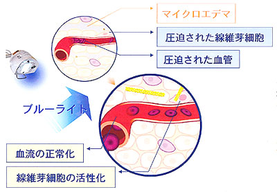 ブルーライトによるスキンデトックスとアクネケア